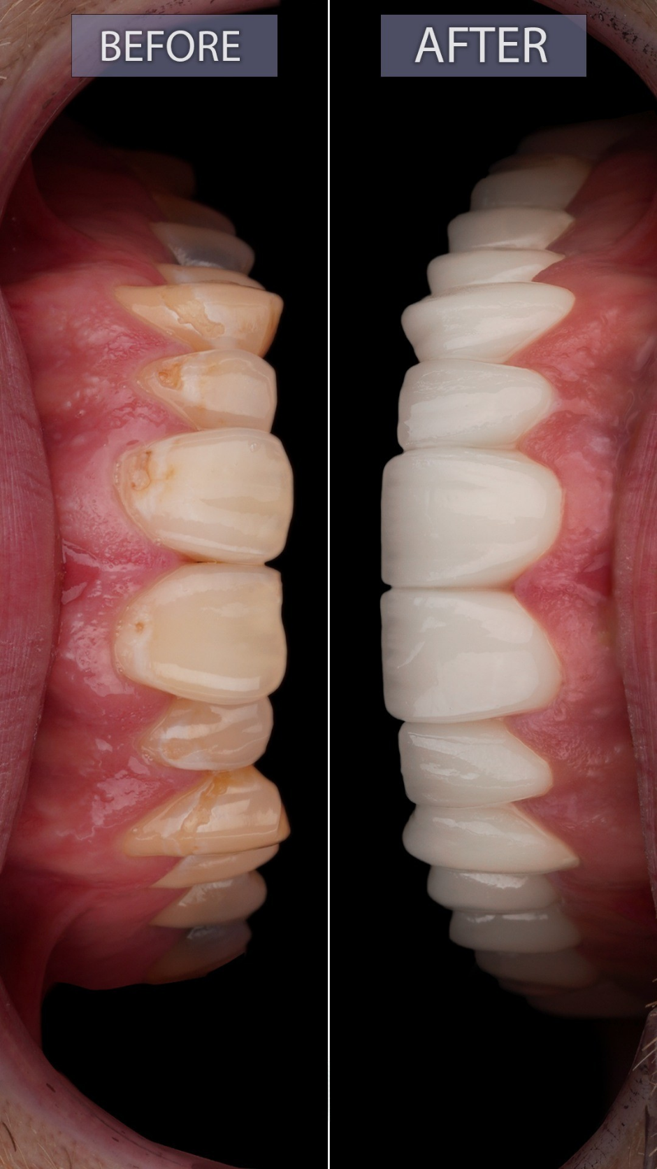Before and after smile transformation — Patient Result 4