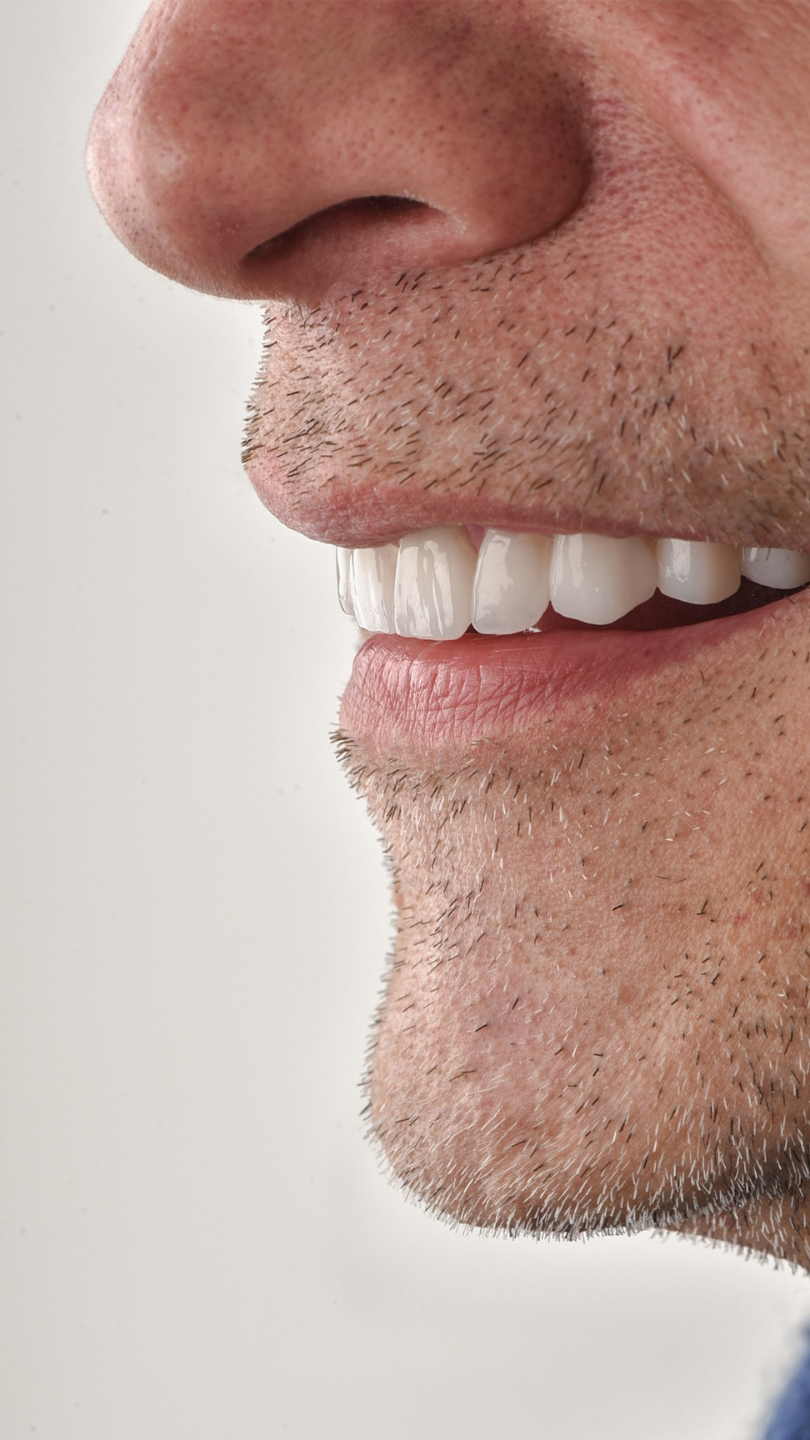 Before and after smile transformation — Patient Result 1